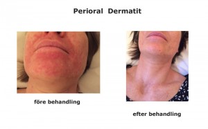 Perioral dermatit